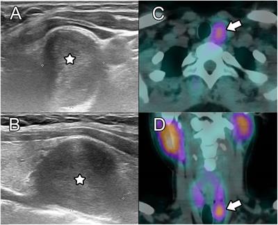 Esophageal schwannoma mimicking non-functional parathyroid adenoma on 99mTc-sestamibi imaging: a case report